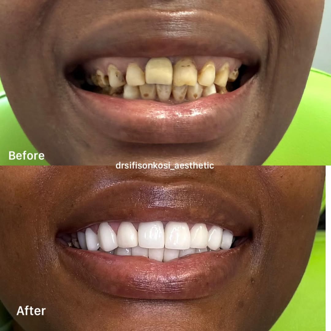 Patient before porcelain veneers