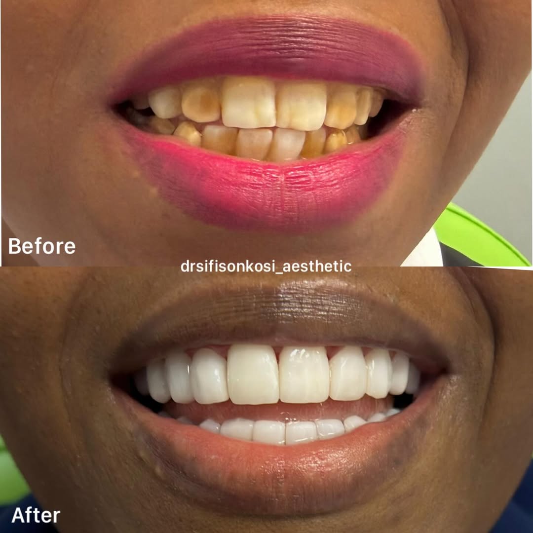Patient after custom porcelain veneers treatment